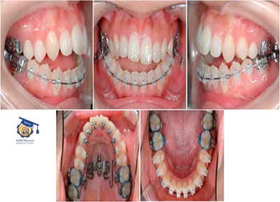 کاربرد آلیاژهای تیتانیوم بتا در دندانپزشکی