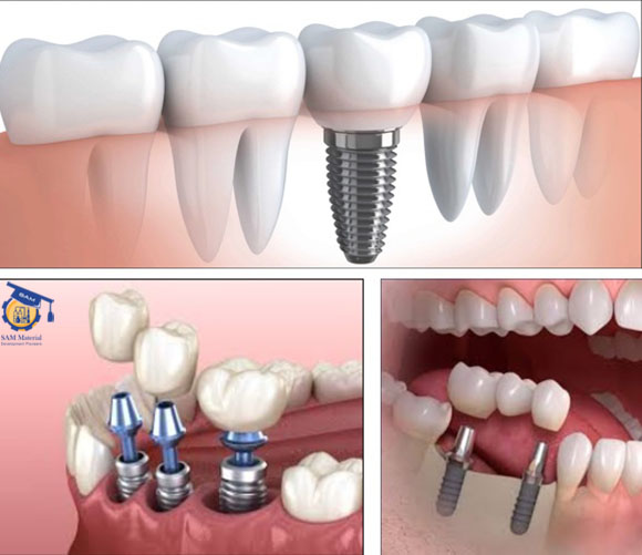 کاربرد آلیازهای تیتانیوم در دندانپزشکی